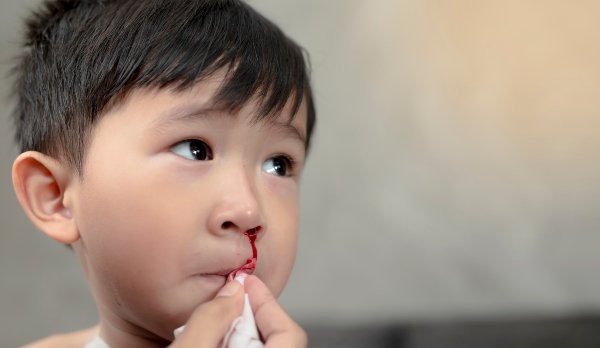 What Causes Nosebleeds in Children?